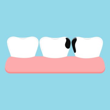 illustration de la carie dentaire