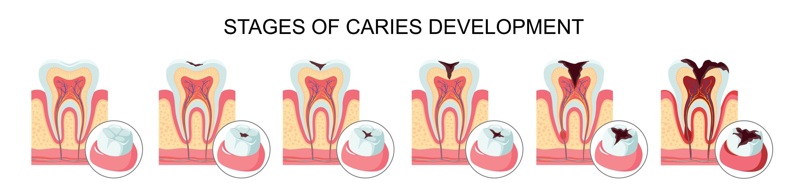 Illustration de la progression de la carie