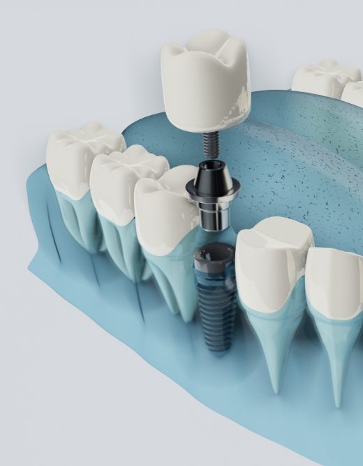 Qu’est-ce qu’un implant dentaire ?