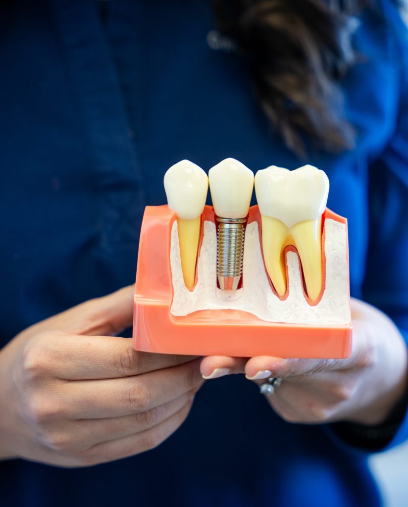 Implant_dentaire_a_Laval Modele d'implant dentaire